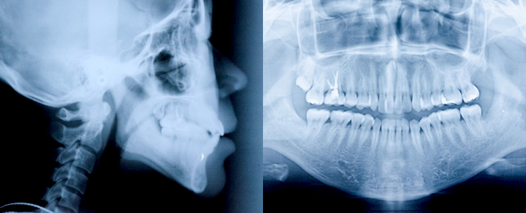 矯正治療の精密検査
